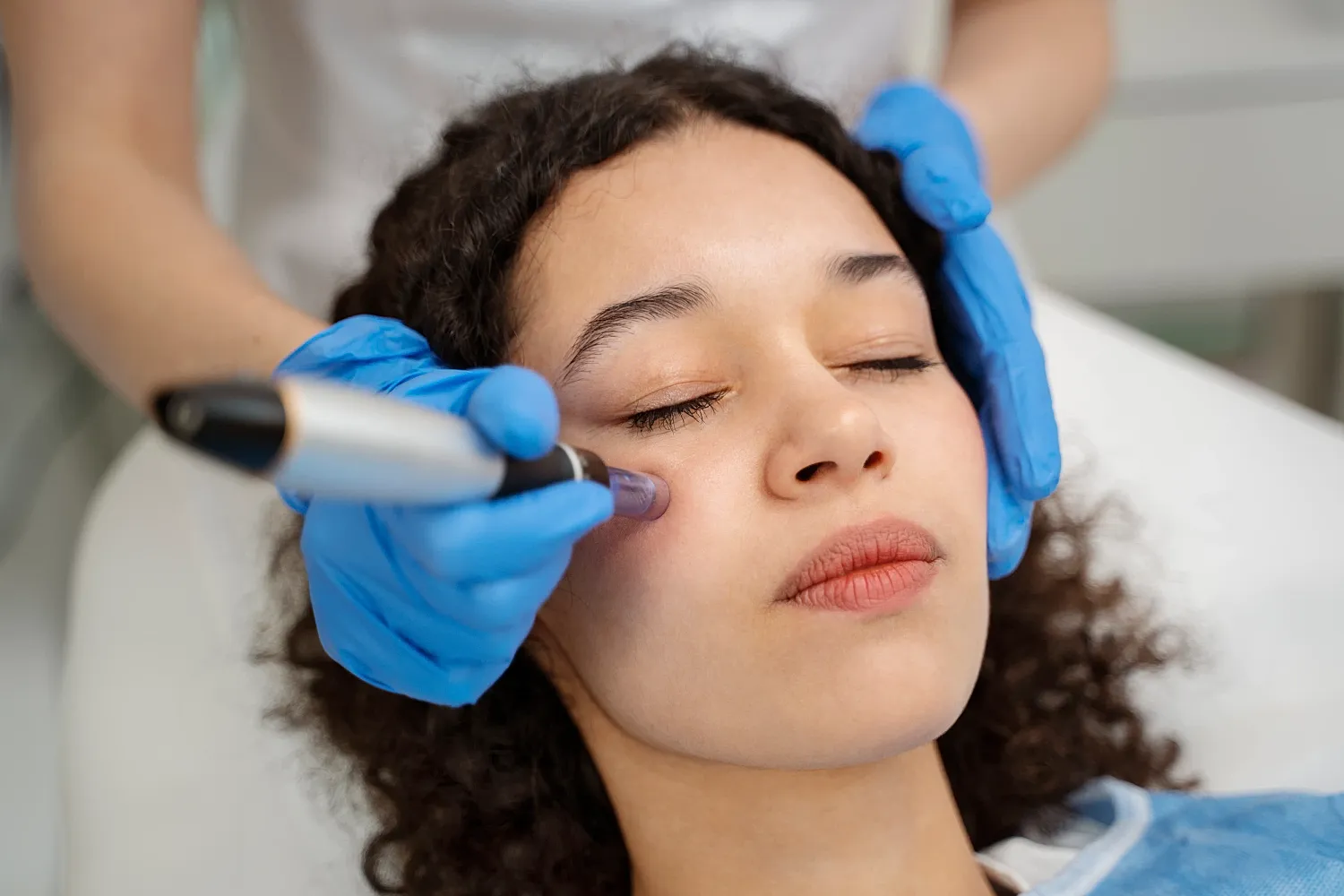 Microneedling Vs. RF Microneedling – Which is Better?