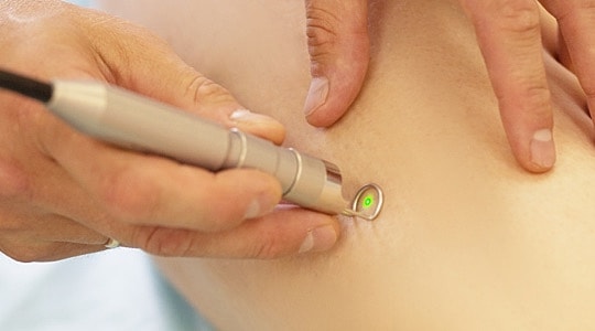 Laser treatment on a patient's skin.