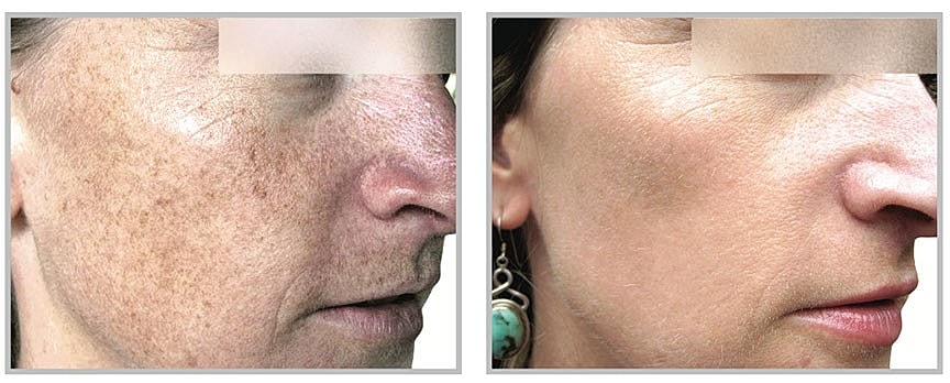 Skin condition before and after treatment comparison.