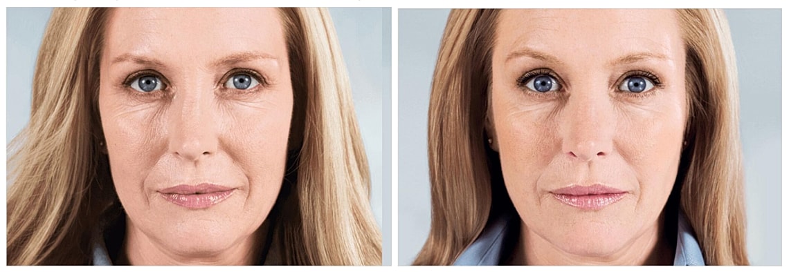 Before and after photo of a woman's face.