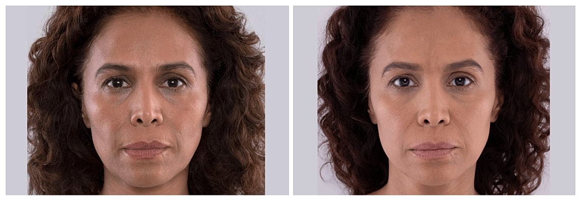 Before and after facial treatment comparison image.