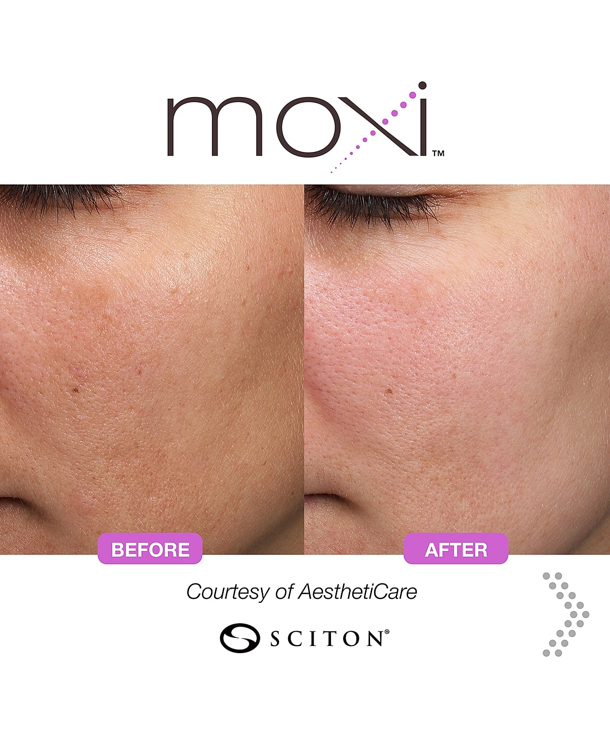 Moxi treatment before and after skin results.