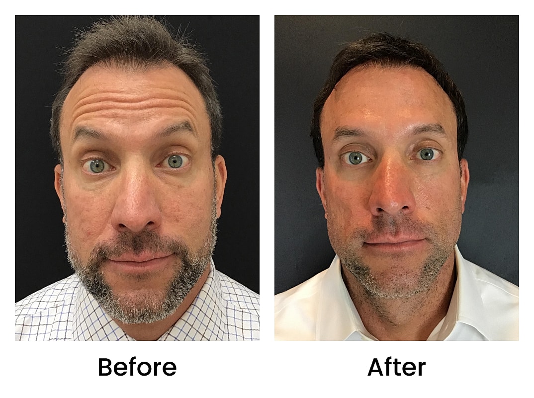 Botox Before & After