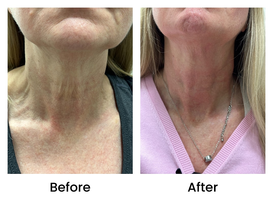 Botox Before & After