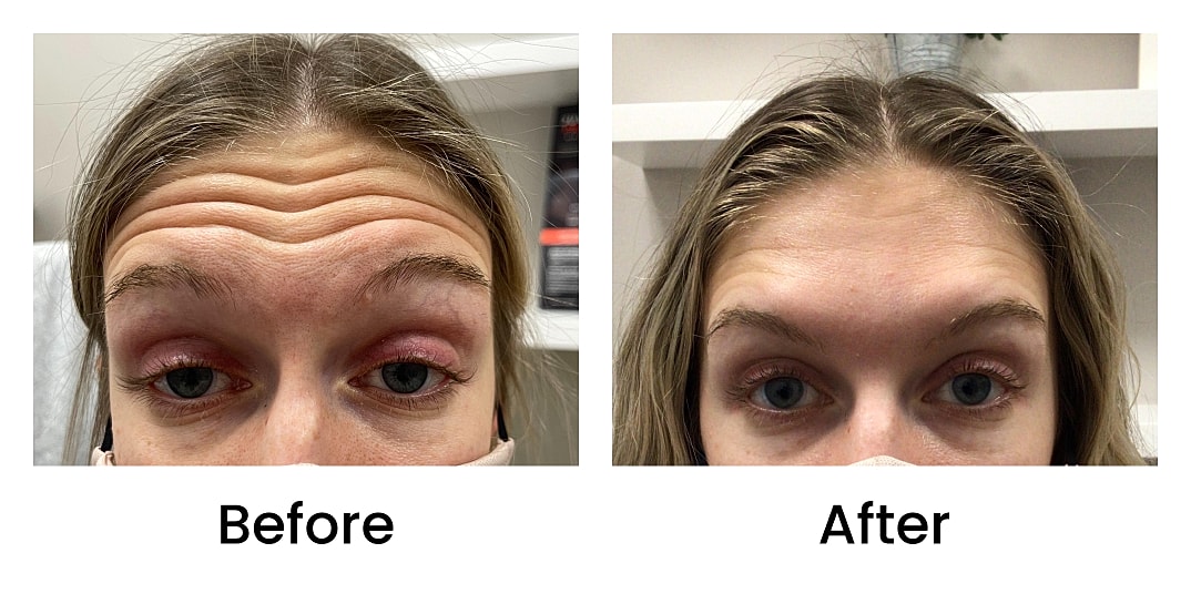 Botox Before & After