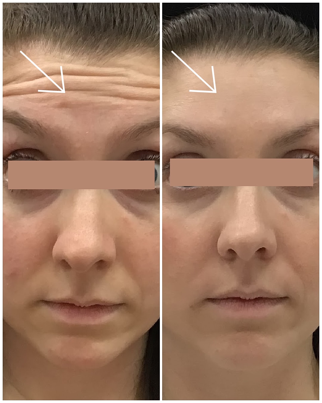 Before and after wrinkle treatment comparison image.