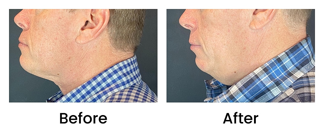 Coolsculpting Before & After