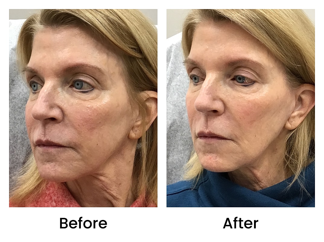 Triple Remedy Before & After