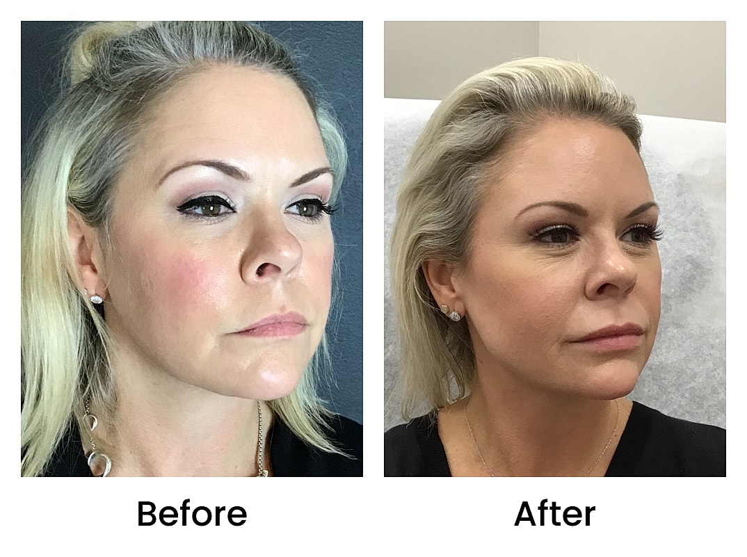 Dermal Fillers Before & After