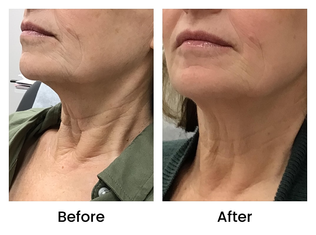 SKINVIVE  Before & After