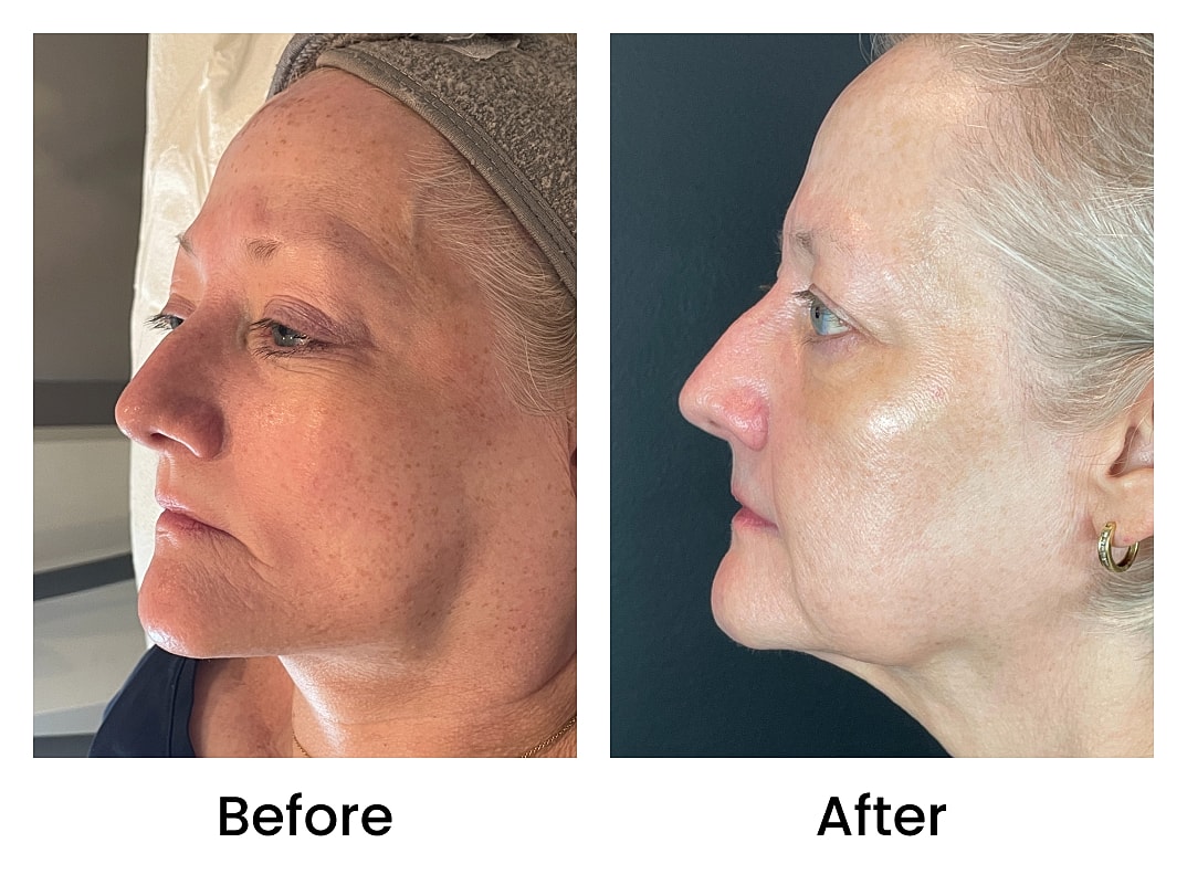 Bbl Laser Before & After