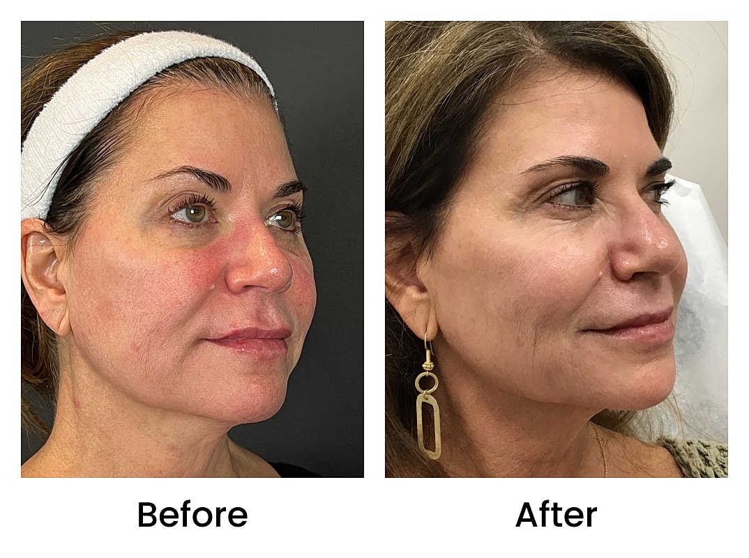 Bbl Laser Before & After