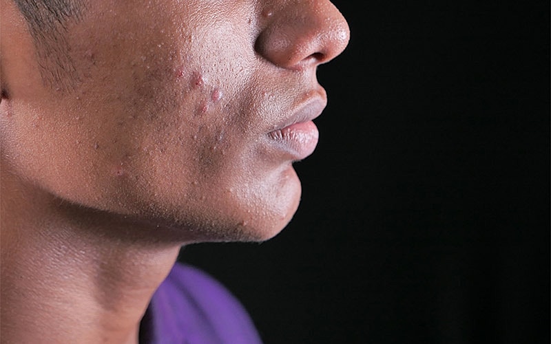 Close-up of male face with acne.