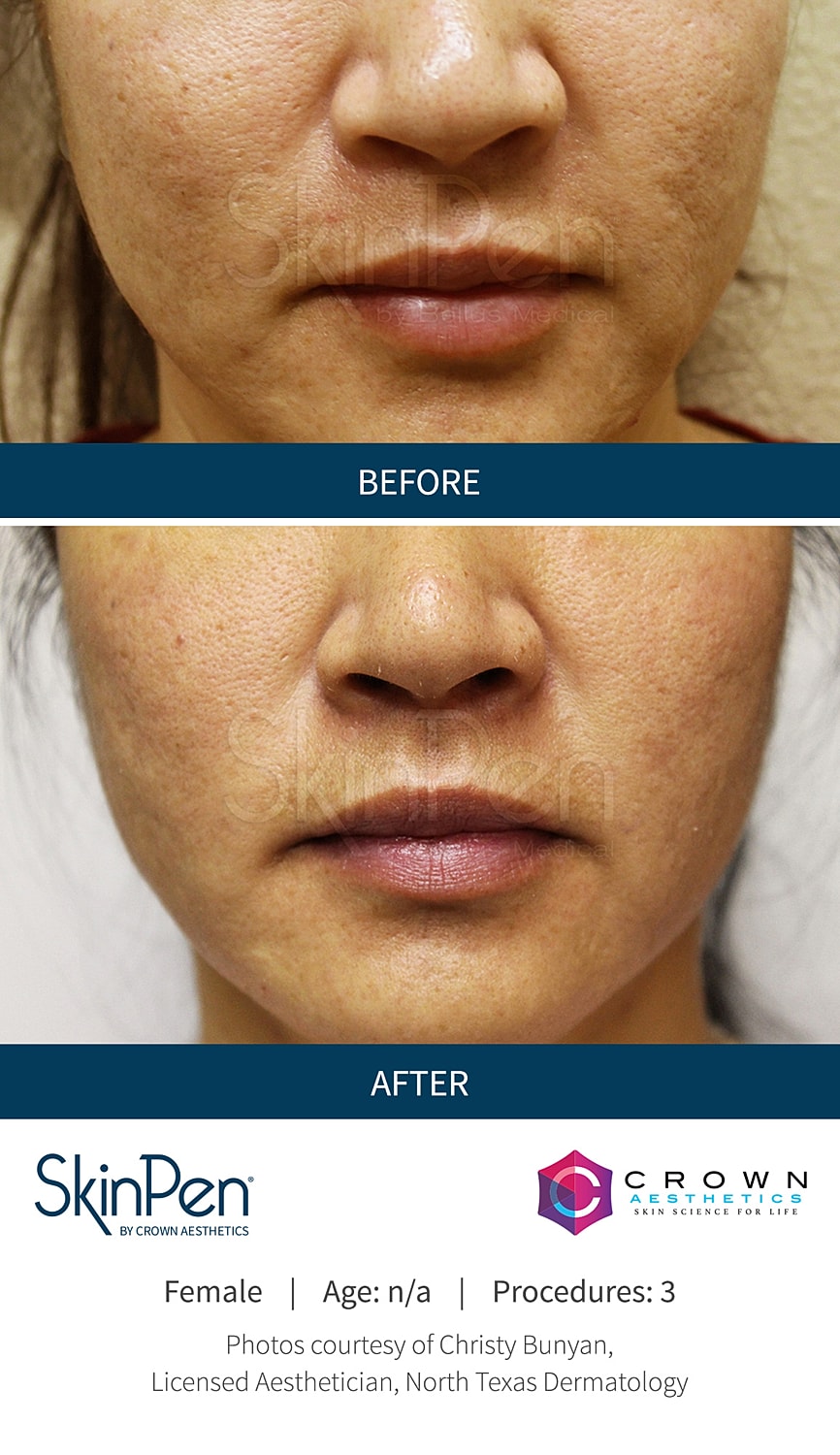 Skin rejuvenation results: before and after comparison.