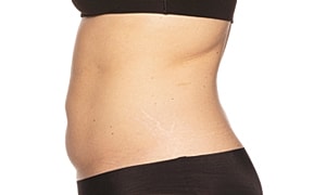 Side view of abdomen with stretch marks.