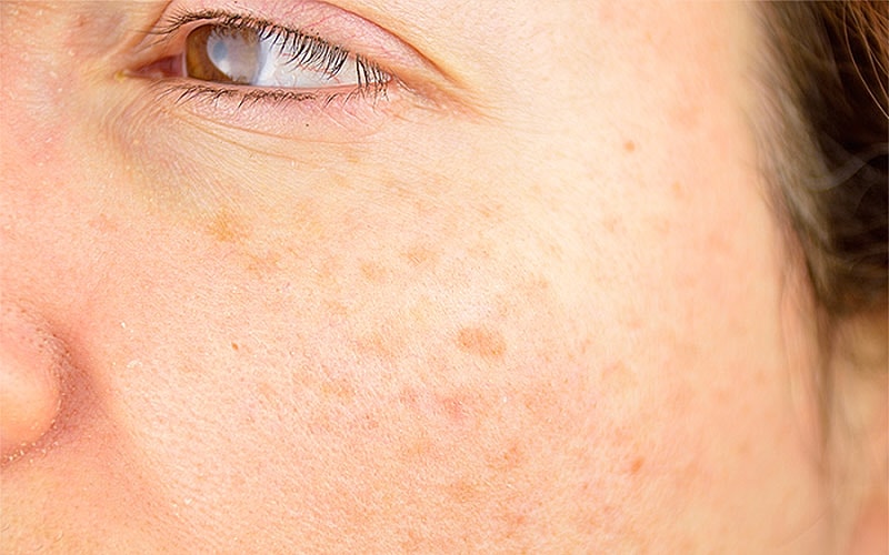 Close-up of skin with blemishes and spots.