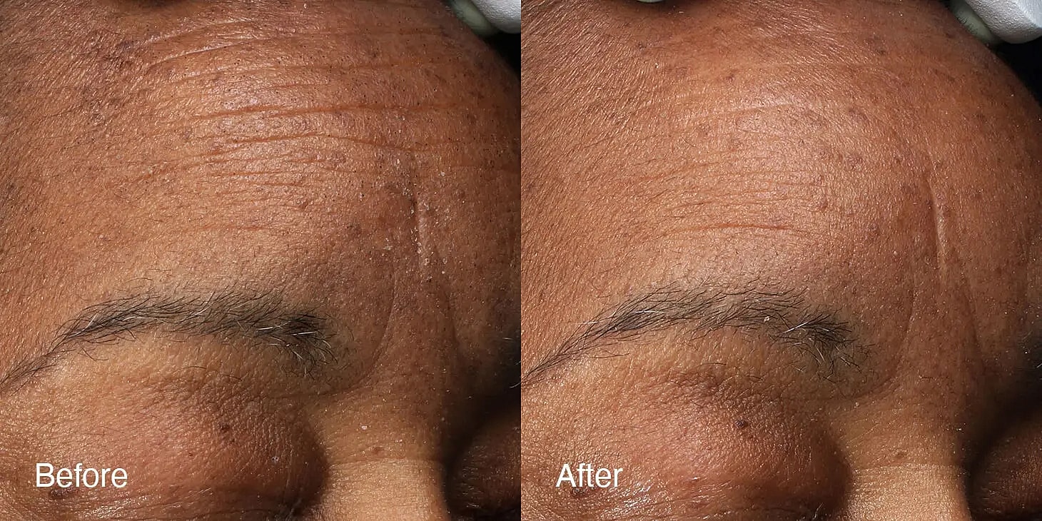 Before and after skin treatment results.
