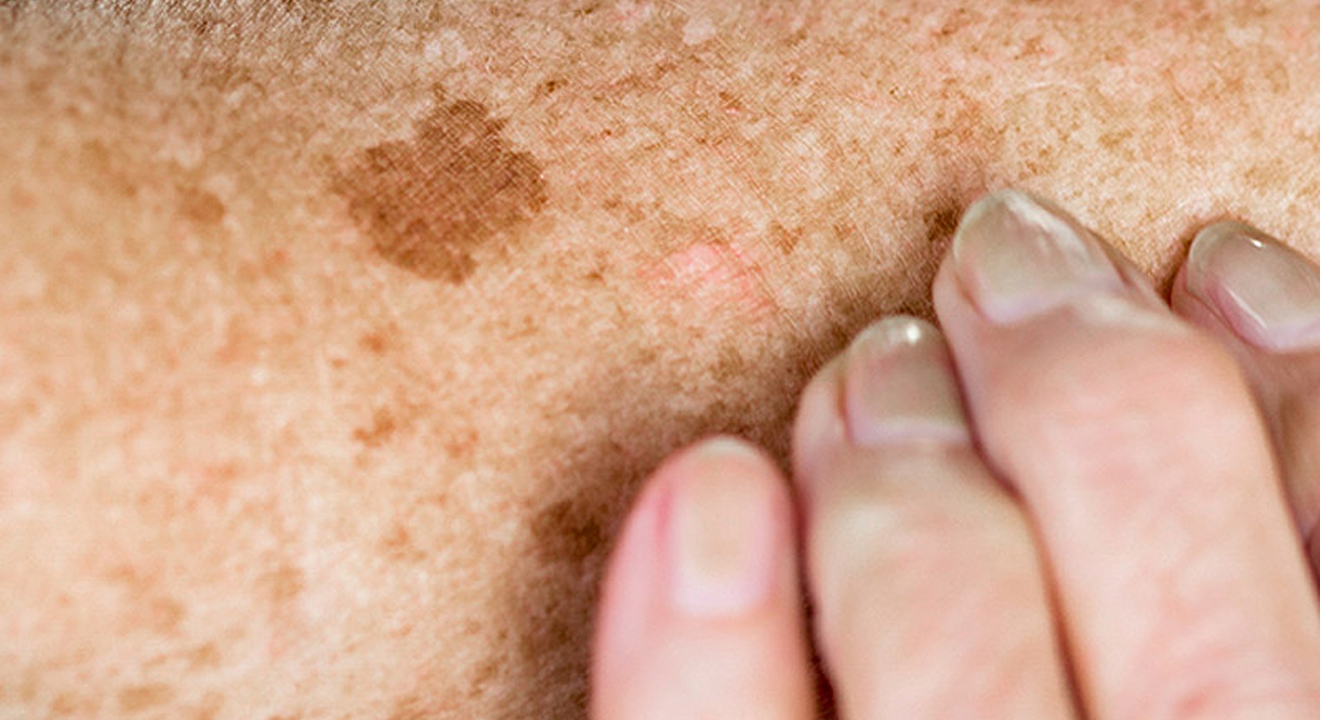 Close-up of skin with pigmentation changes.