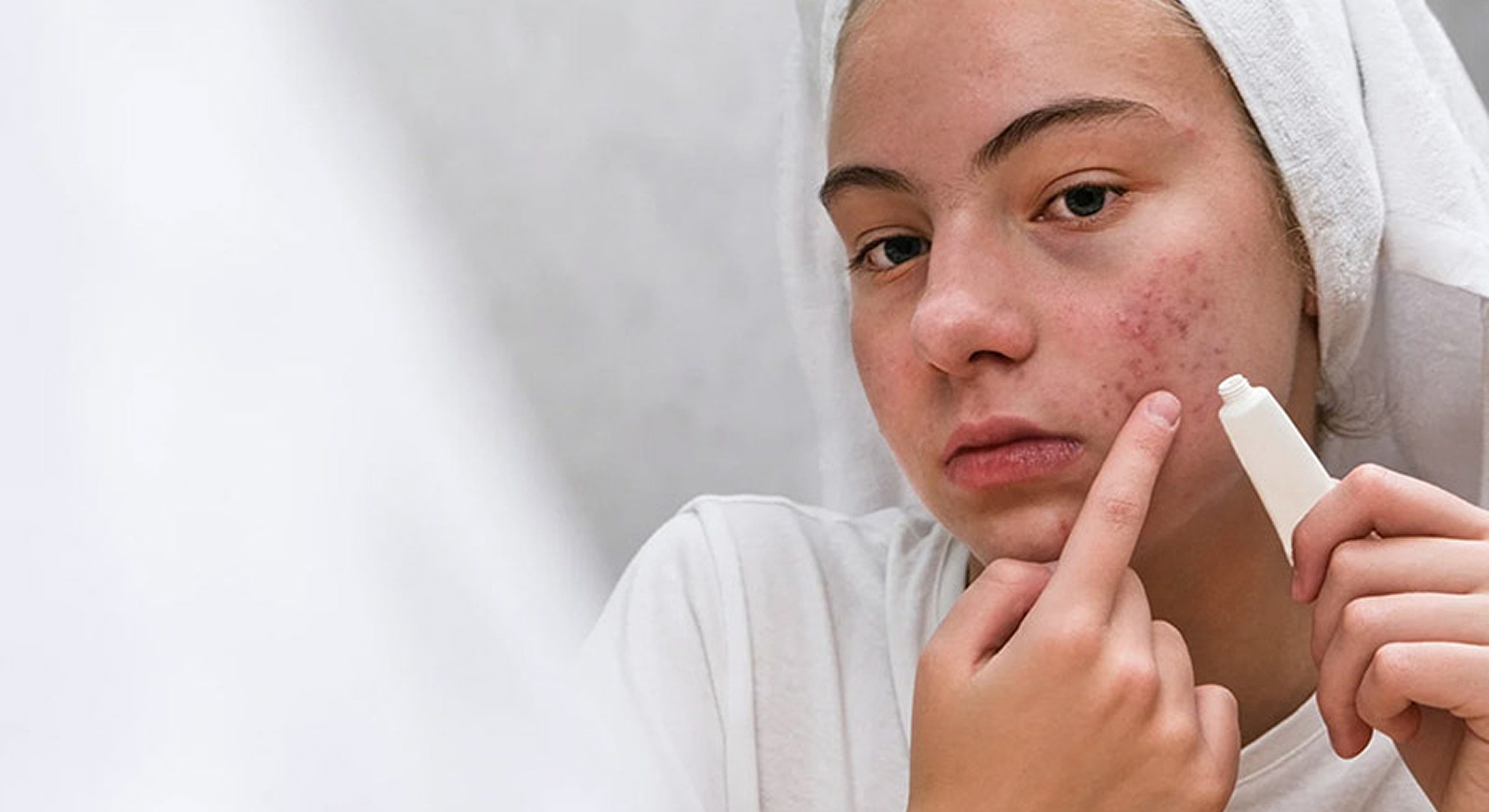 Young person applying skincare for acne treatment.