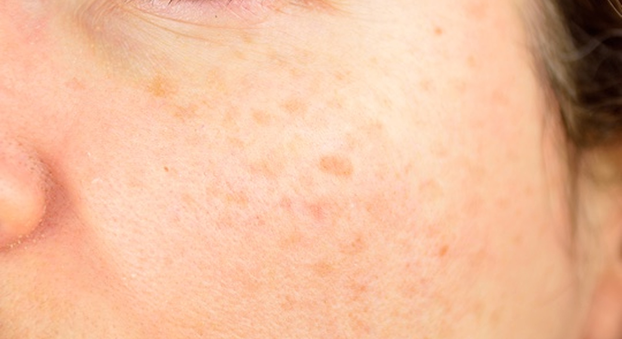 Close-up of textured facial skin with blemishes.