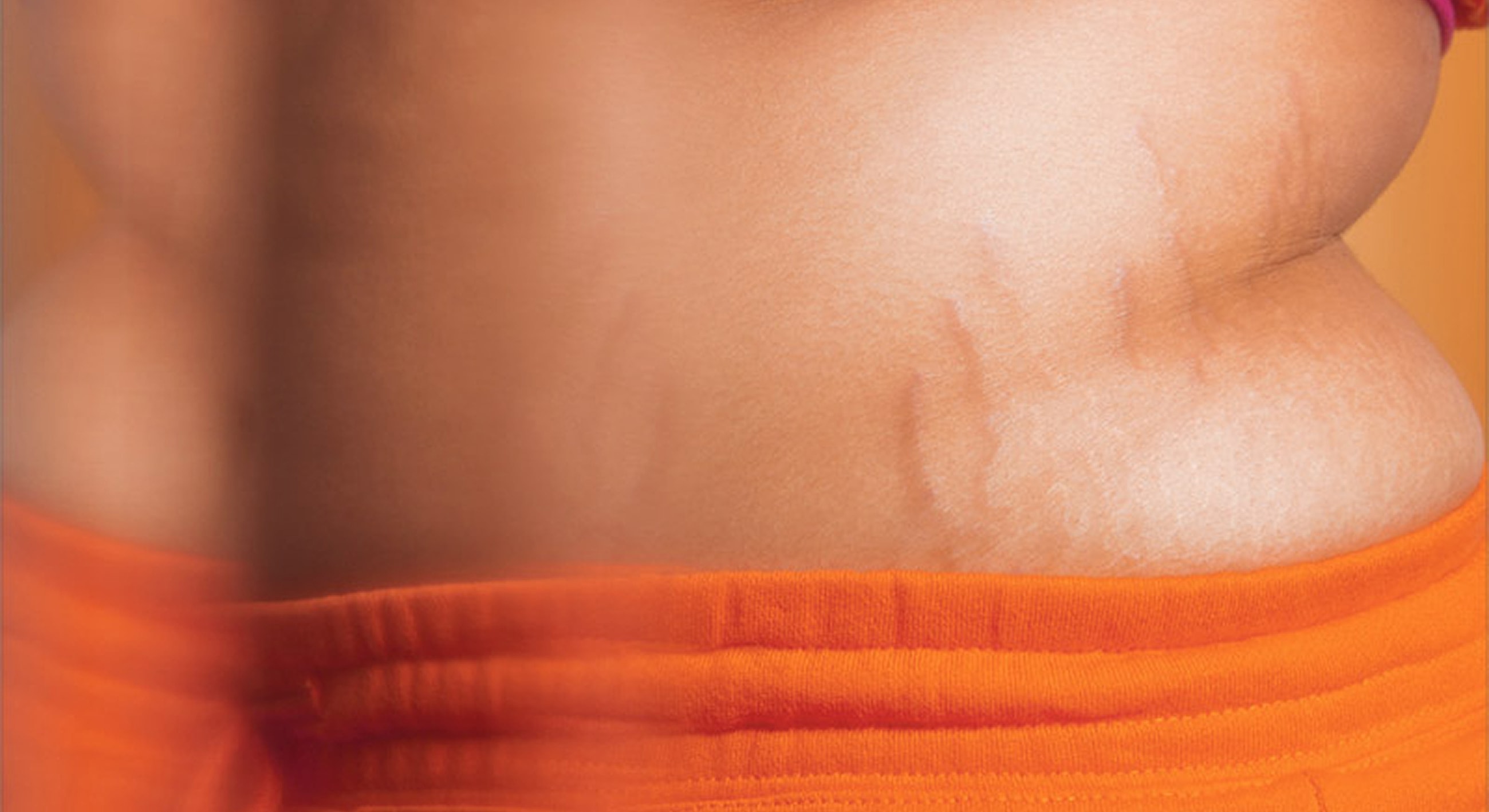 Close-up of belly with stretch marks.