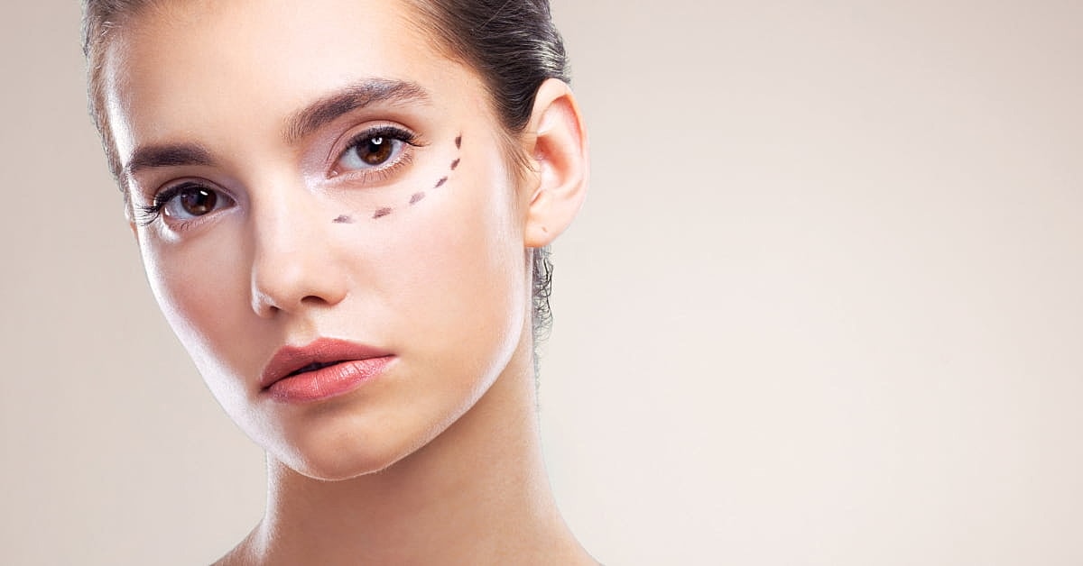 Close up of a woman with markings on her under eye area to indicate where the dermal filler will be placed