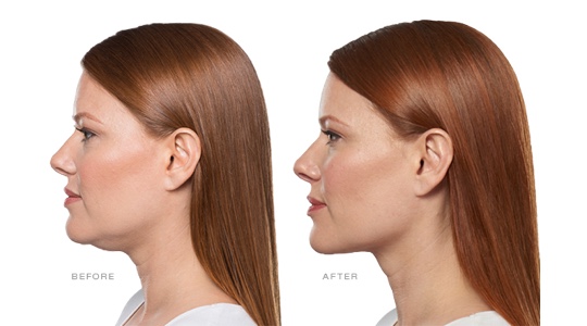 Kybella results - before and after images of a woman's chin