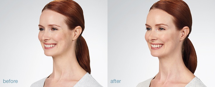 botox cosmetic before and after result