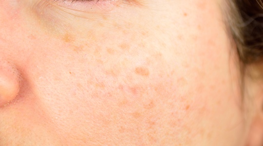 Brown spots on a women's skin - cheekbone area