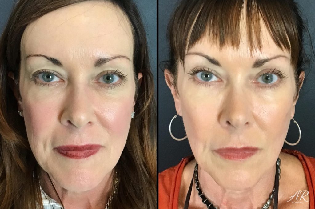 Before and after photos of a female treated with dermal fillers