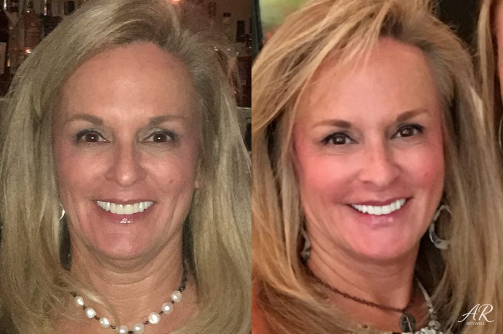Before and after images of a woman who got dermal fillers treatments