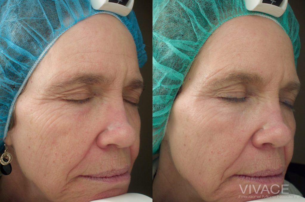 Before and after images of a woman who received Vivace RF Microneedling on her face