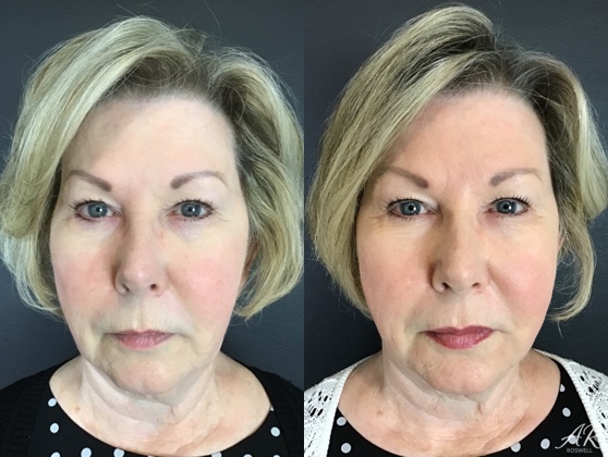 Before and after images of a woman who had dermal filler treatments