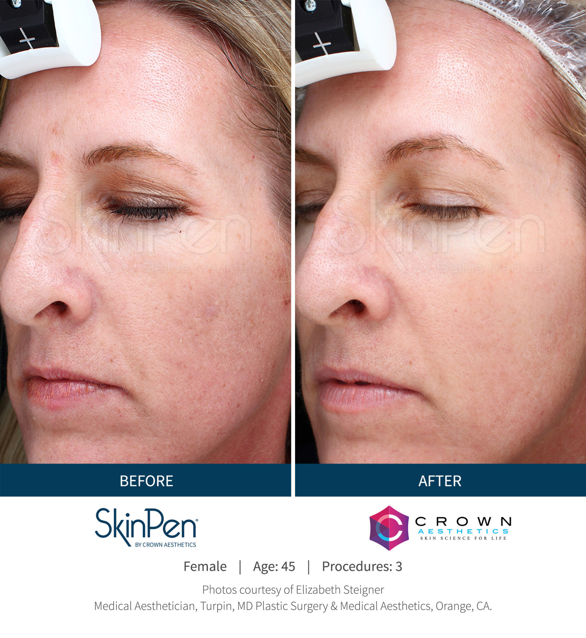 SkinPen Microneedling in Roswell, GA SkinPen Before and After