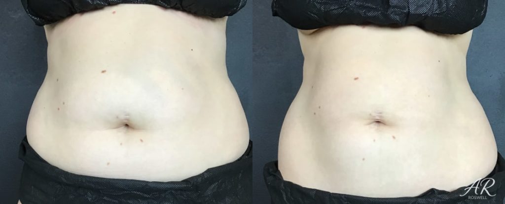 Woman's abdomen (front) before and after treatment with CoolSculpting
