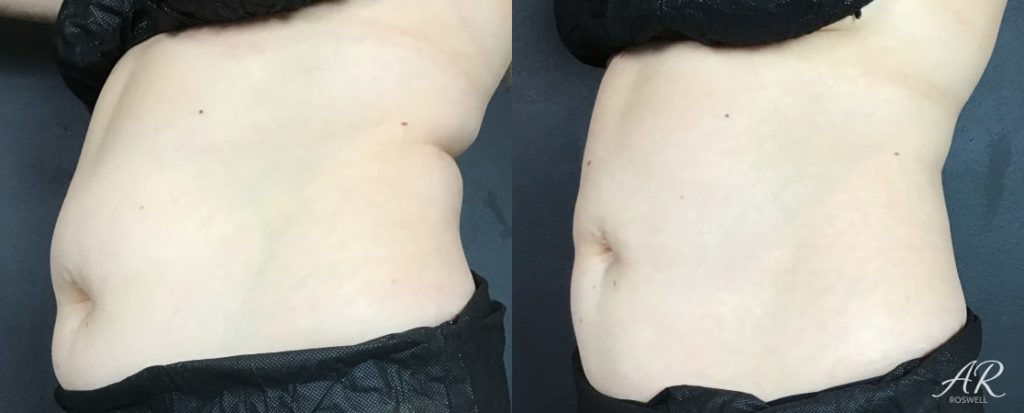Woman's abdomen (left flank) before and after treatment with CoolSculpting
