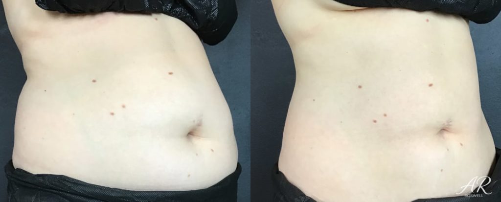 Woman's abdomen (right flank) before and after treatment with CoolSculpting