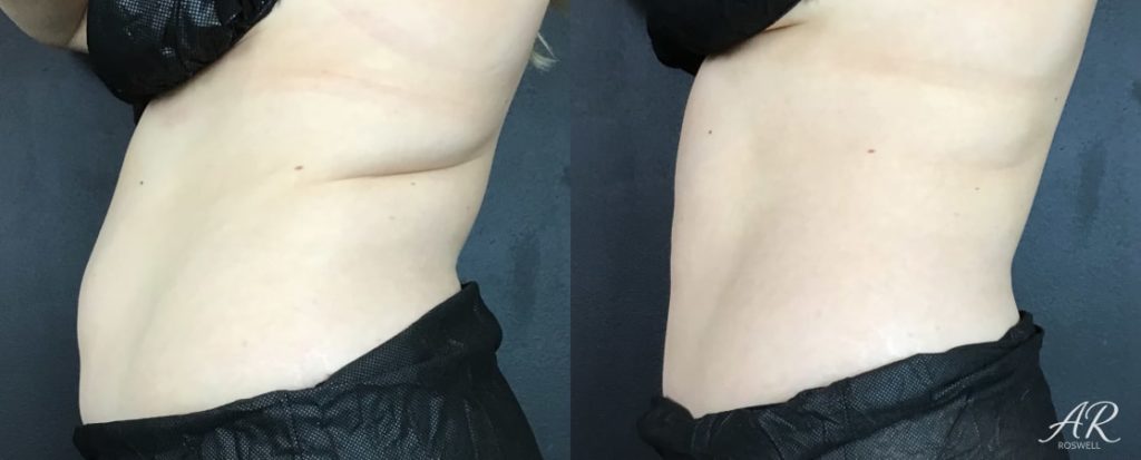 Woman's abdomen (left side) before and after treatment with CoolSculpting