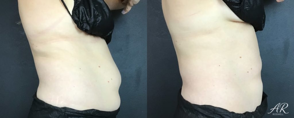 Woman's abdomen (right) before and after treatment with CoolSculpting