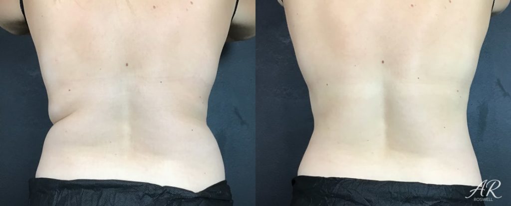 Woman's abdomen (back) before and after treatment with CoolSculpting