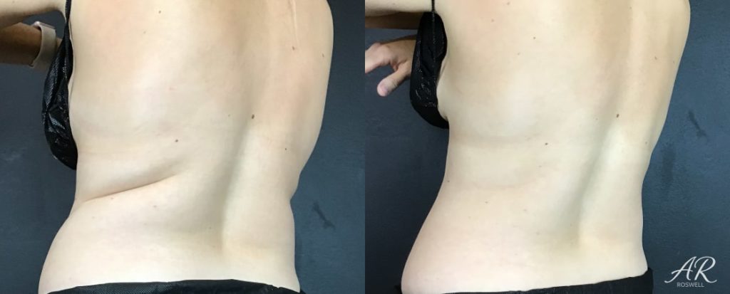 Woman's abdomen (back left) before and after treatment with CoolSculpting