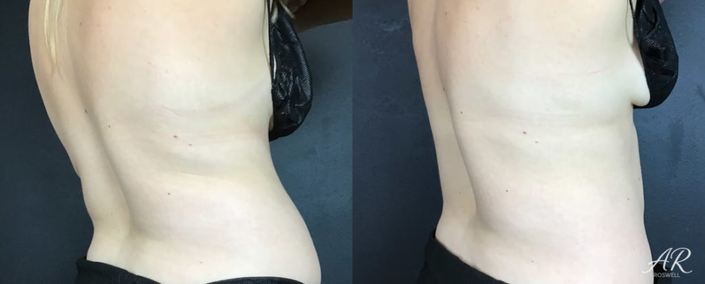 Woman's abdomen (back right) before and after treatment with CoolSculpting