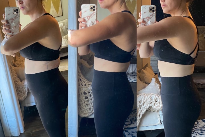 Before and After CoolSculpting Treatment at Ageless Remedies (Left Side)