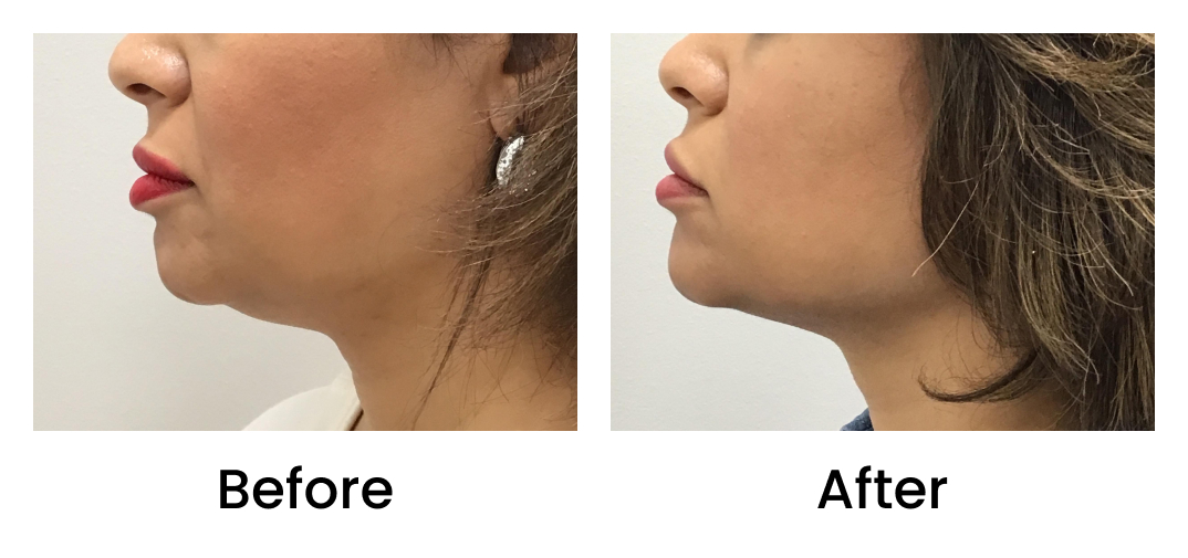 kybella